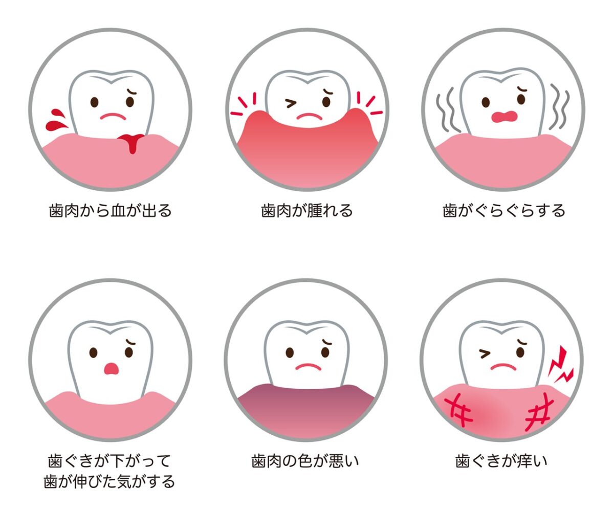 歯ぐきの腫れ・出血は歯周病のサイン…?