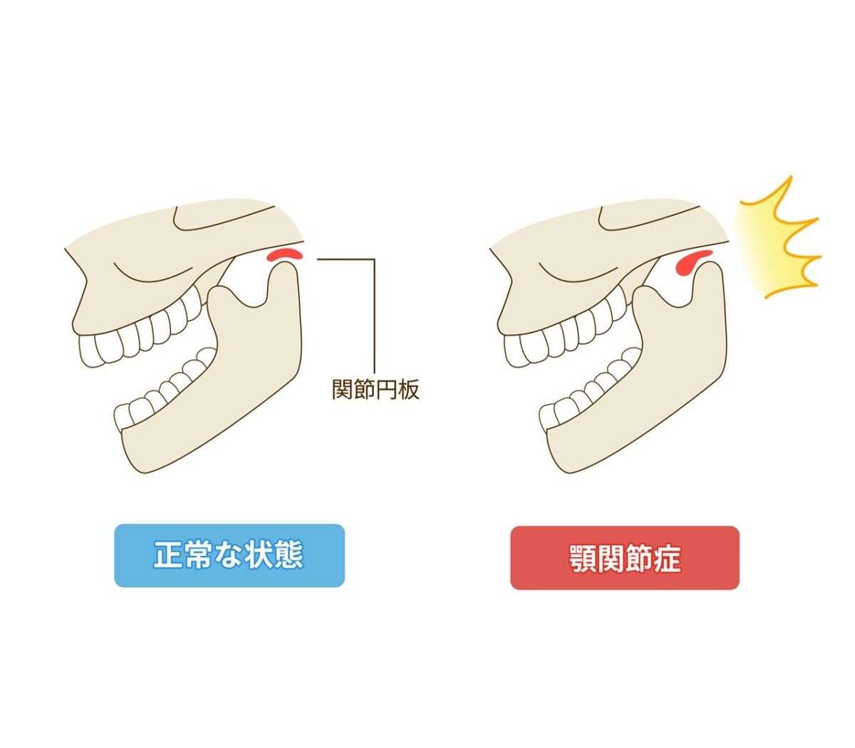 顎関節症について